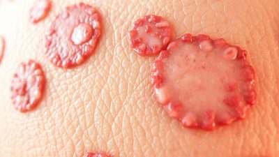 Dermatitis Numularis diagnosis