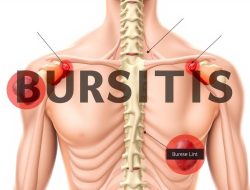 Bursitis: Gejala, Penyebab, dan Pengobatannya
