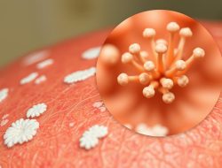 Penyakit Candidiasis: Gejala, Penyebab, dan Pengobatan