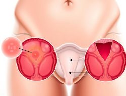 Mengenal Penyakit Chlamydia: Gejala dan Penanganannya