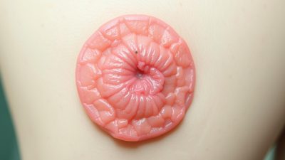 Kenali Gejala dan Penanganan Penyakit Dermatitis Numularis