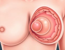 Memahami Penyakit Fibroadenoma: Gejala, Penyebab, dan Penanganan