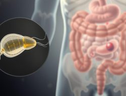 Penyakit Giardiasis: Apa yang Perlu Anda Ketahui?