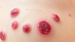 Mengenal Penyakit Granuloma Inguinale: Gejala dan Pengobatan
