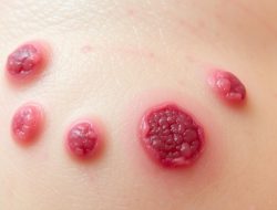Mengenal Penyakit Granuloma Inguinale: Gejala dan Pengobatan