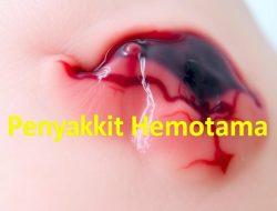 Penyakit Hematoma: Apa yang Perlu Anda Ketahui?