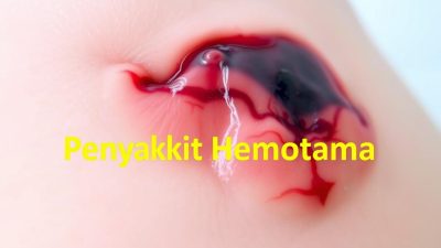 Penyakit Hematoma: Apa yang Perlu Anda Ketahui?
