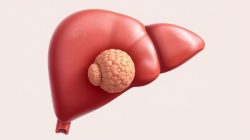 Memahami Penyakit Hepatoblastoma: Gejala, Penyebab, dan Pengobatan