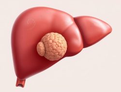Memahami Penyakit Hepatoblastoma: Gejala, Penyebab, dan Pengobatan