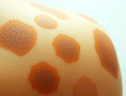 Hyperpigmentation 101: What You Need to Know