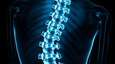 diagnosis kifosis dengan X-ray diagnosis kifosis dengan X-ray