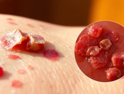 Penyakit Impetigo: Apa yang Perlu Anda Ketahui?