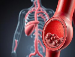 Penyakit Iskemia: Memahami Kondisi Medis yang Mempengaruhi Aliran Darah