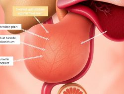 Mengenal Penyakit Kolesistitis: Gejala, Penyebab, dan Pengobatan