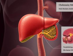 Penyakit Kolestasis: Apa yang Perlu Anda Ketahui?
