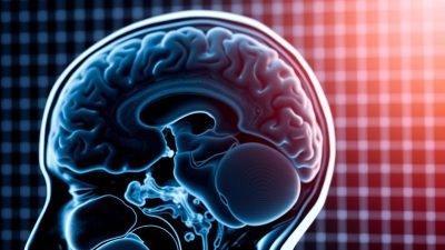 MRI Malformasi Chiari