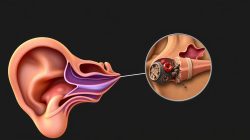 Mengatasi Penyakit Labirinitis: Panduan Lengkap