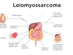 Memahami Penyakit Leiomyosarcoma: Gejala, Penyebab, dan Pengobatan