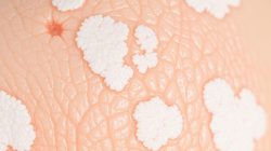 Memahami Penyakit Lichen Sclerosus: Gejala dan Penanganan