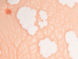 Memahami Penyakit Lichen Sclerosus: Gejala dan Penanganan