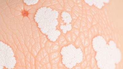 penyakit Lichen Sclerosus