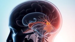 Memahami Malformasi Chiari: Gejala, Penyebab, dan Penanganan